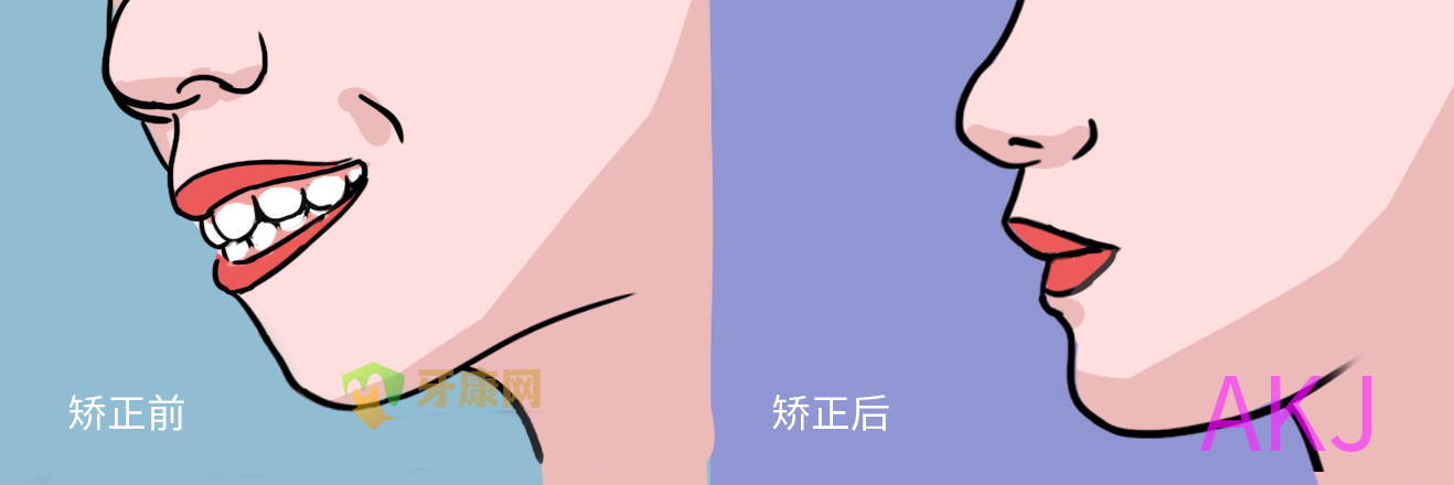深覆盖