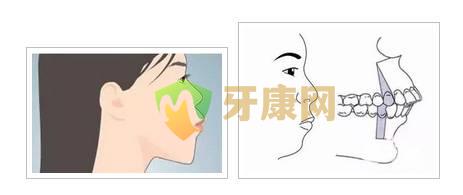 牙齿反颌、牙齿对脸型的影响到底有多大？